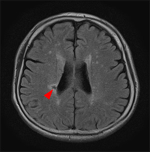 無症候性脳梗塞