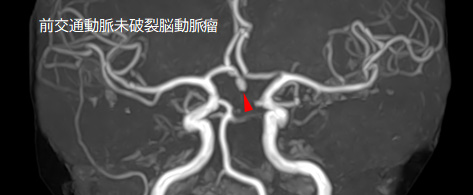 未破裂脳動脈瘤