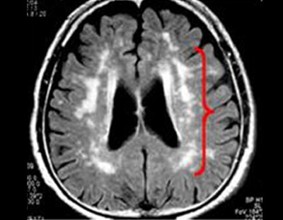 大脳白質病変